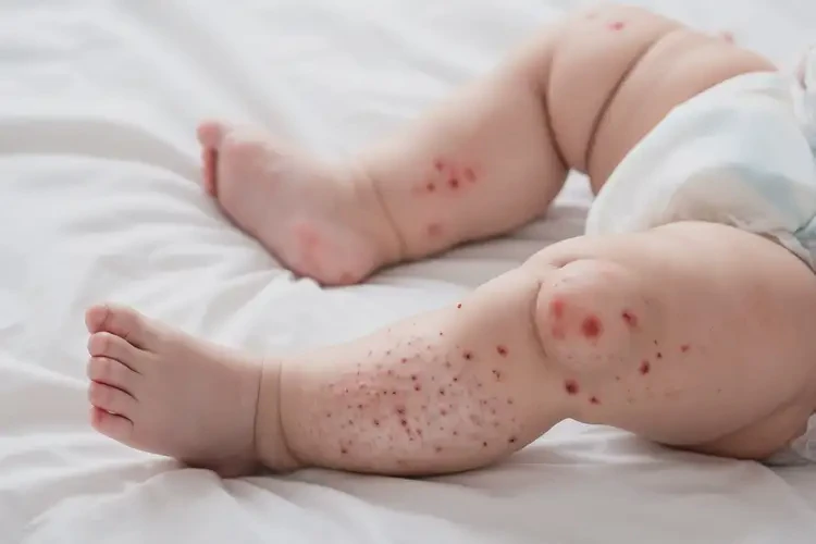 宝宝大腿有湿疹能彻底自愈吗(图2)