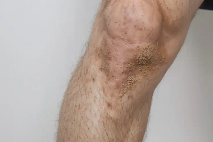 男生小腿上長濕疹不管它會自己好嗎(圖1)