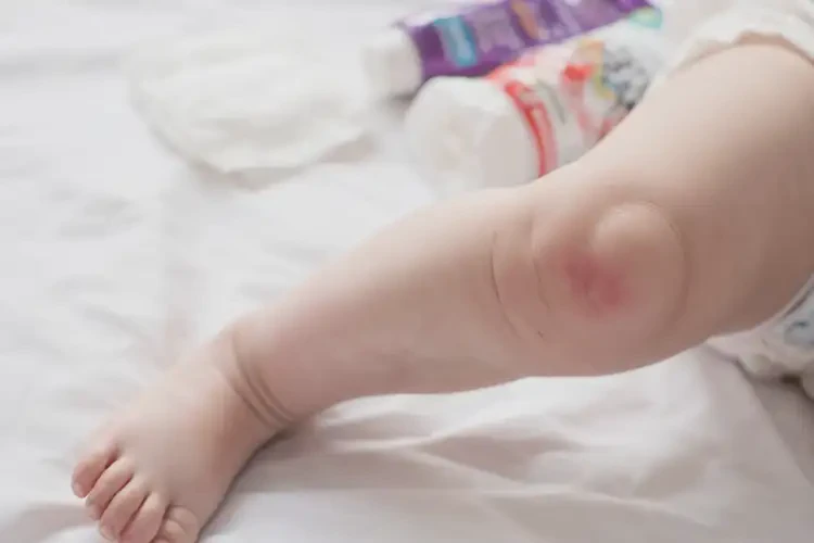 嬰兒大腿長(zhǎng)濕疹可以治好嗎(圖4)