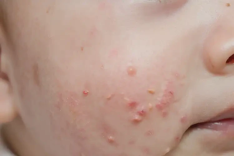婴儿脸上偶尔起湿疹可不可以根治(图4)
