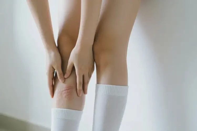 女生小腿出現(xiàn)濕疹不管它會自己自愈嗎(圖2)