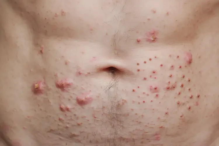 男性肚子上起濕疹可不可以根治(圖4)