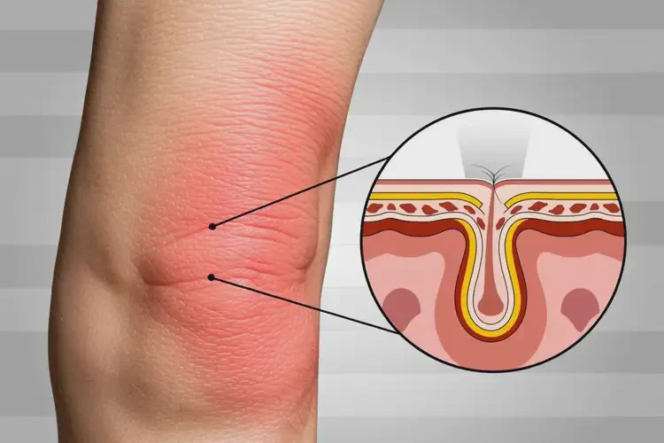 老人小腿上容易長濕疹可不可以根治(圖1)