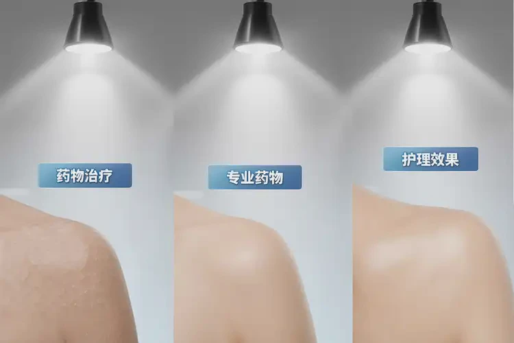 男性屁股經(jīng)常長濕疹可不可以根治(圖3)