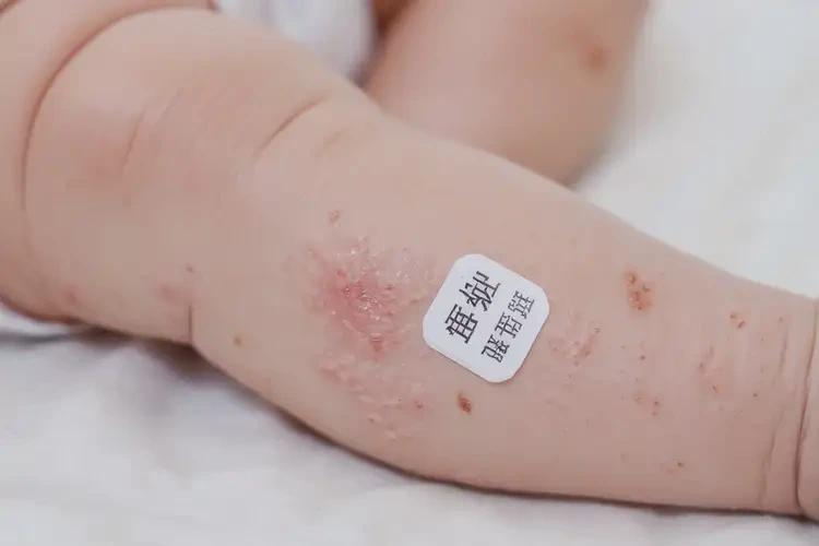 新生兒小腿上出濕疹不管它會(huì)自己自愈嗎(圖4)