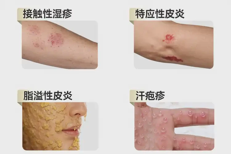 大學(xué)生腳上出現(xiàn)濕疹可不可以根治(圖3)