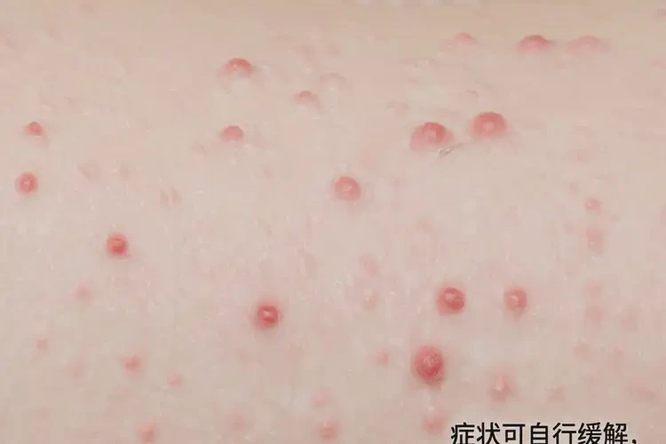 男人大腿上出濕疹可不可以徹底自愈(圖3)