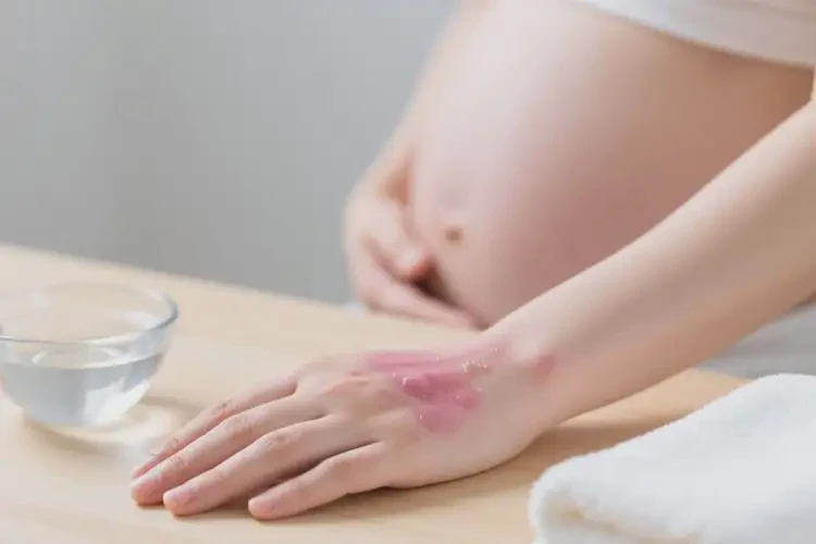 孕婦手上經(jīng)常起濕疹可不可以根治(圖3)