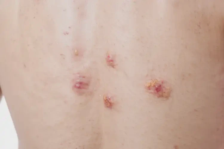 青年人四肢偶爾長濕疹不管它會自己好嗎(圖1)