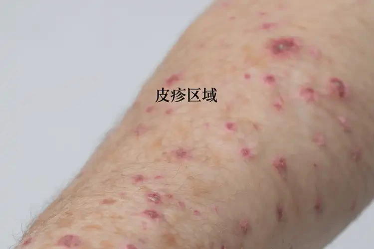 男性手臂上偶爾長濕疹可不可以根治(圖4)