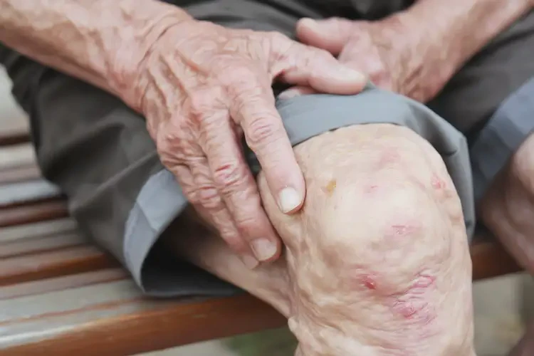 高齡老人小腿經(jīng)常長濕疹能不能根治(圖4)