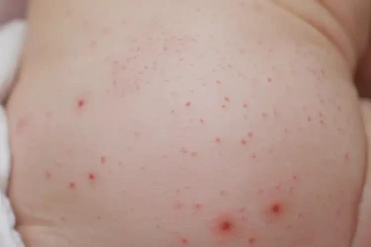 新生兒屁股上起濕疹可以徹底自愈嗎(圖4)