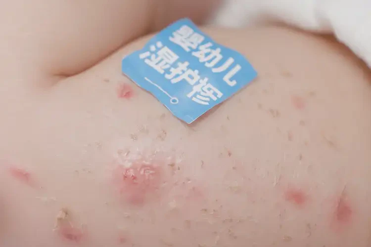 孩子屁股經(jīng)常起濕疹可不可以根治(圖4)