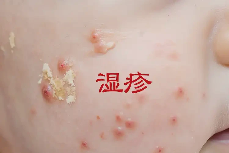 嬰兒面部出現(xiàn)濕疹可不可以根治(圖4)