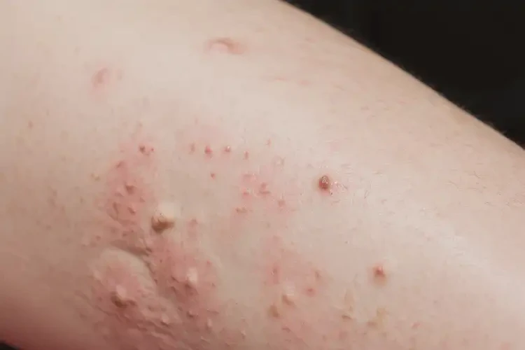 孕婦小腿容易起濕疹可不可以根治(圖4)