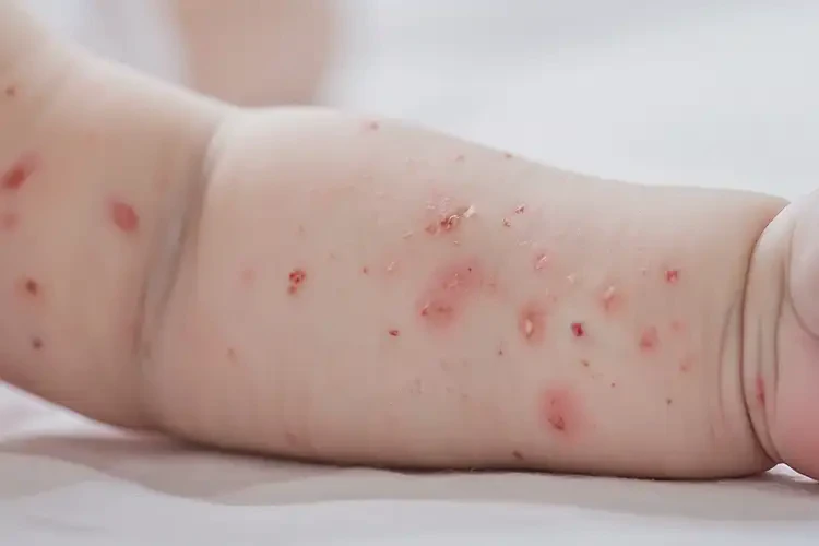 嬰兒手臂上偶爾長濕疹可不可以根治(圖4)