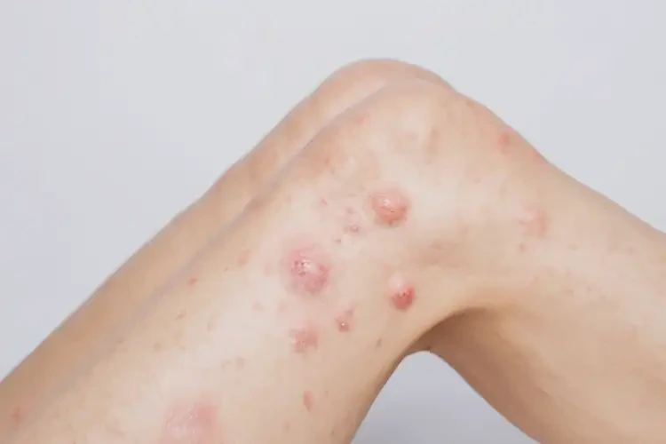 女生小腿上出現(xiàn)濕疹可以徹底自愈嗎(圖4)