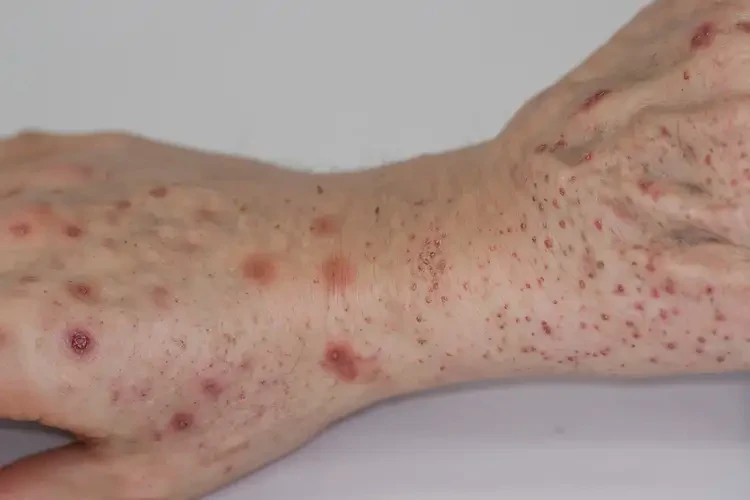 女性四肢容易長(zhǎng)濕疹可不可以根治(圖4)