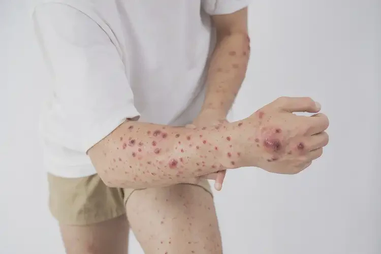 青年人全身偶爾長(zhǎng)濕疹可不可以根治(圖4)