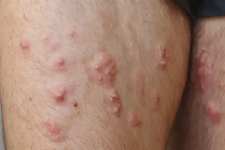 男人大腿上有濕疹可不可以根治(圖4)