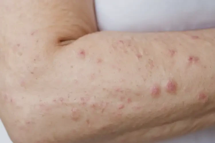 女人手臂出現(xiàn)濕疹不管它會自己自愈嗎(圖4)