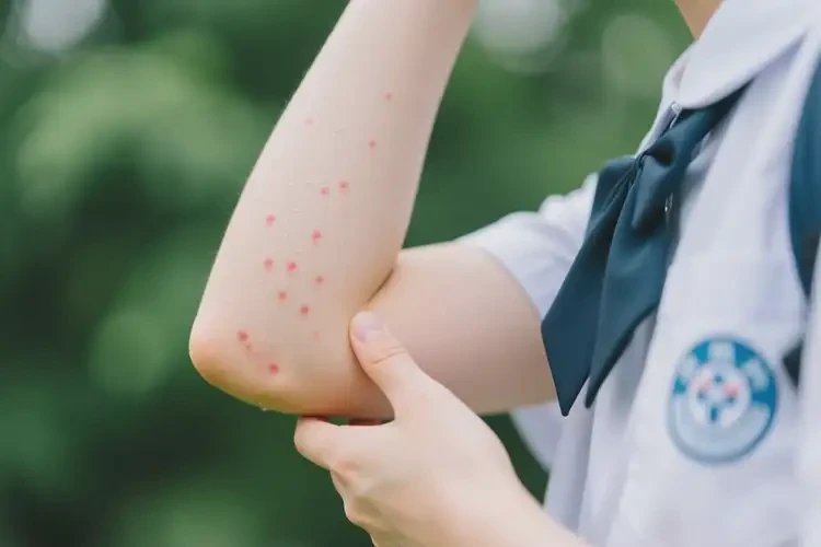 大學(xué)生手臂容易長(zhǎng)濕疹可不可以根治(圖4)