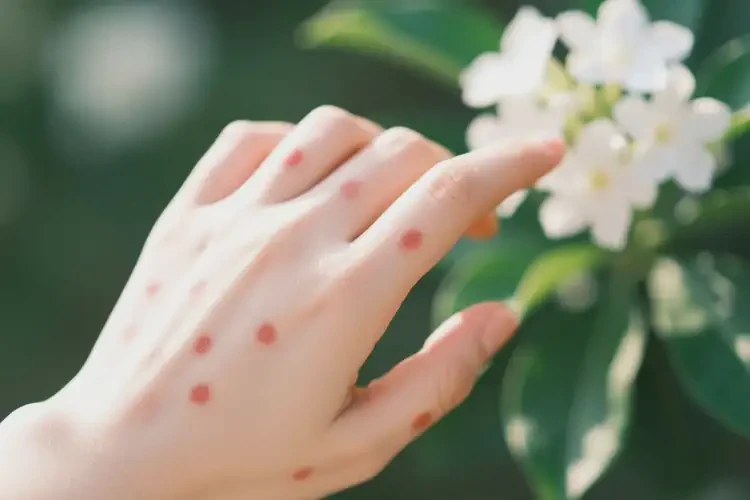 女生手上偶爾起濕疹可不可以根治(圖4)