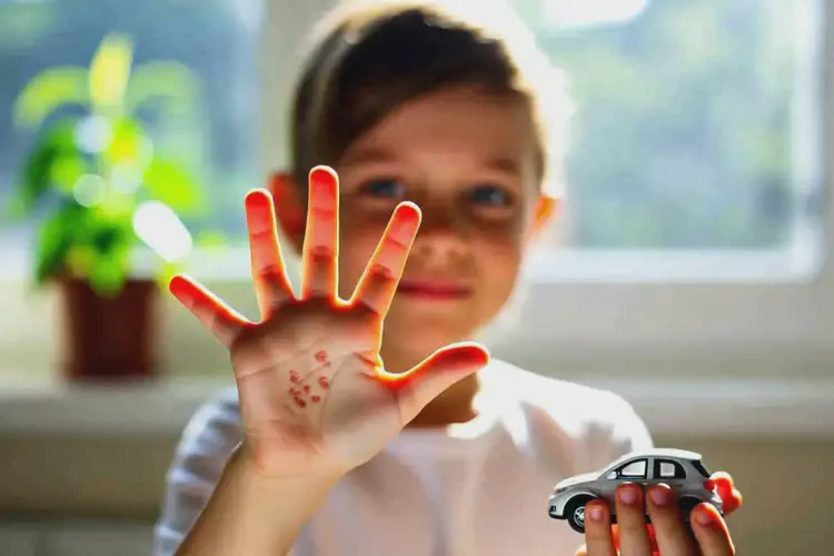 小孩手上經(jīng)常起濕疹可以治好嗎(圖1)