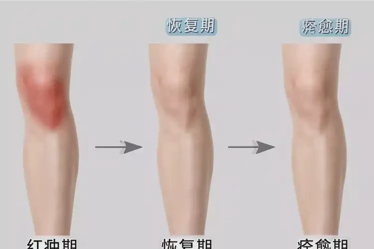 產(chǎn)婦小腿出現(xiàn)濕疹可不可以根治(圖4)