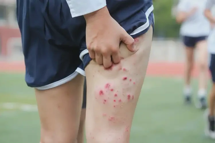 中學(xué)生屁股上出濕疹可不可以根治(圖4)