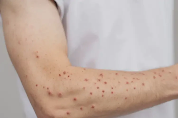 青年人四肢偶爾長濕疹不管它會自己好嗎(圖4)