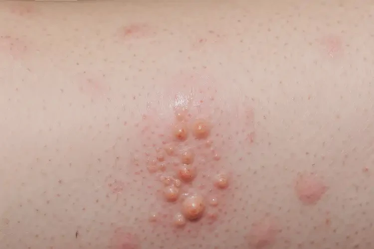 小孩四肢出湿疹可以彻底自愈吗(图4)