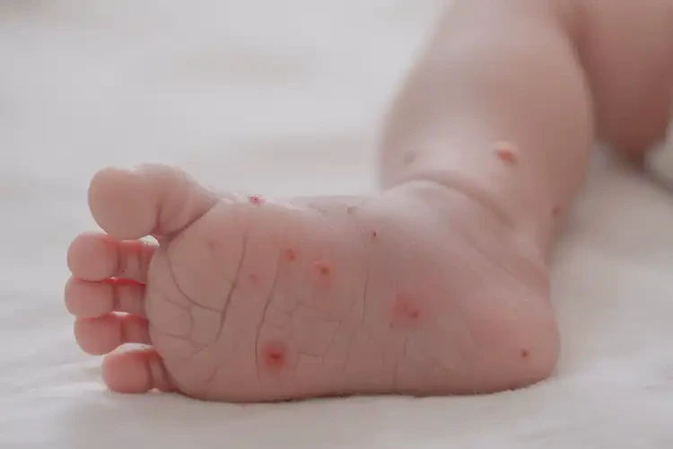 新生兒腳上偶爾長濕疹可不可以根治(圖4)