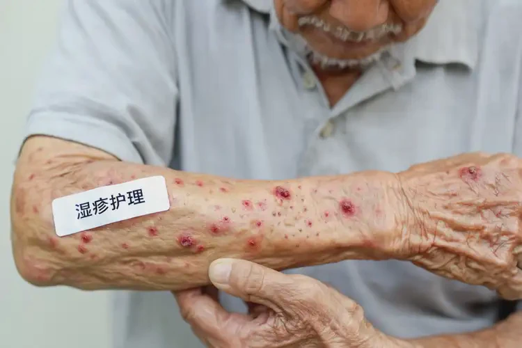 老人手臂上偶爾起濕疹可不可以根治(圖4)