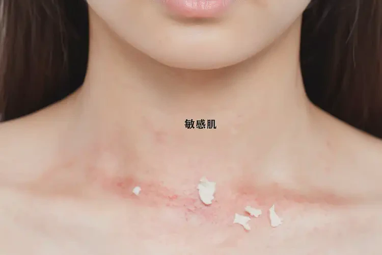 女性脖子經(jīng)常起濕疹可不可以根治(圖4)