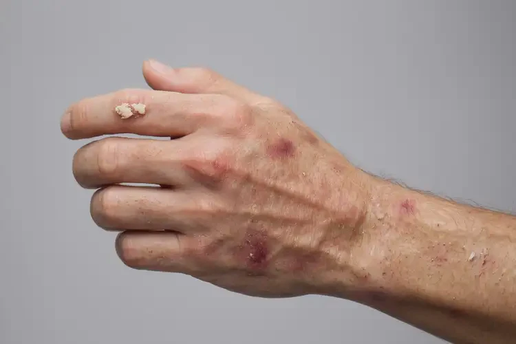 青年人四肢偶爾長濕疹不管它會自己好嗎(圖2)