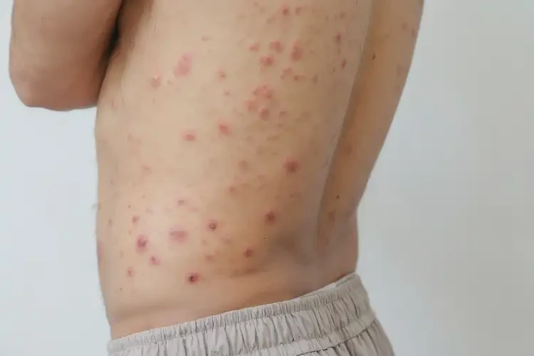 青年人屁股上經(jīng)常起濕疹可不可以根治(圖4)