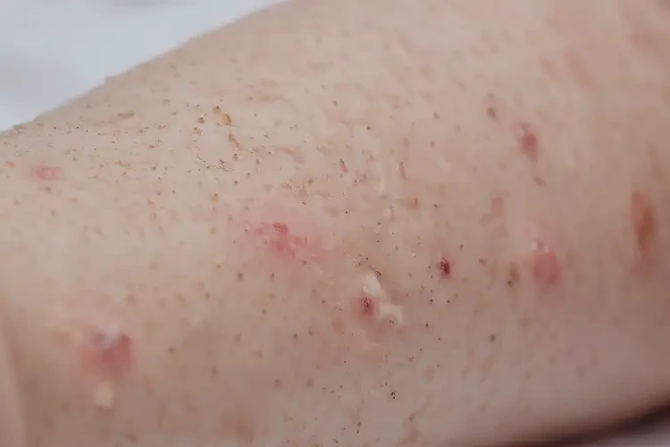 孩子全身出濕疹不管它會(huì)自己痊愈嗎(圖4)