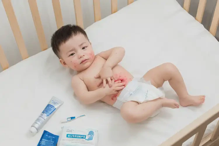 嬰兒肚子出現(xiàn)濕疹可以治好嗎(圖2)