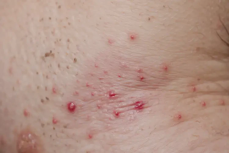 男生肛周偶爾長(zhǎng)濕疹能夠徹底治愈嗎(圖4)