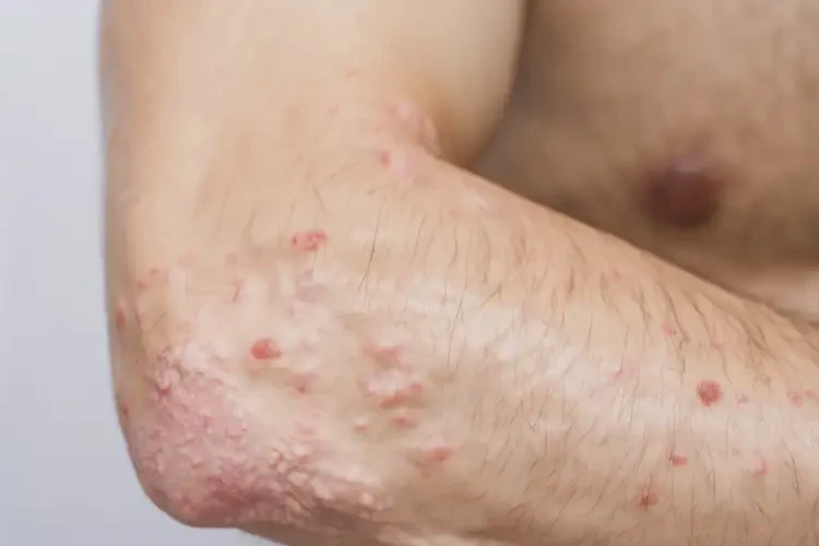 青年人四肢起湿疹可不可以根治(图4)