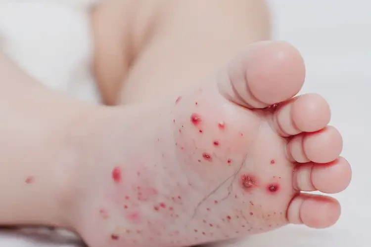 嬰幼兒腳上有濕疹可不可以根治(圖4)