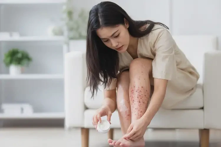 女生腳上出濕疹能夠徹底治愈嗎(圖3)