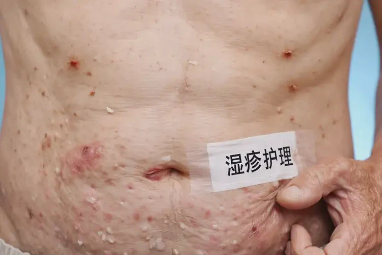 老年人肚子上經(jīng)常長濕疹可不可以根治(圖4)