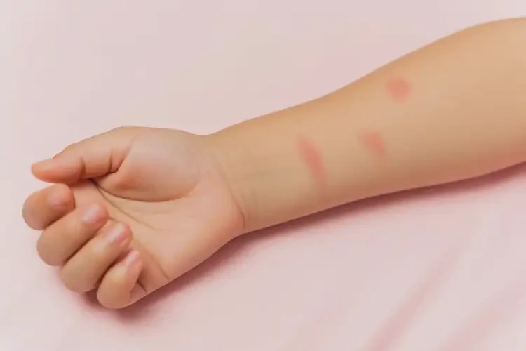 小儿手臂上偶尔起湿疹可不可以根治(图4)