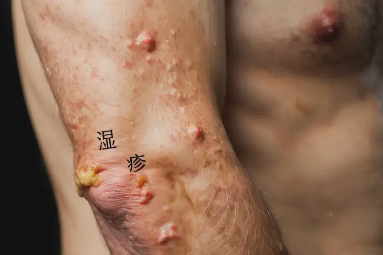 男性手臂經(jīng)常起濕疹可不可以根治(圖4)