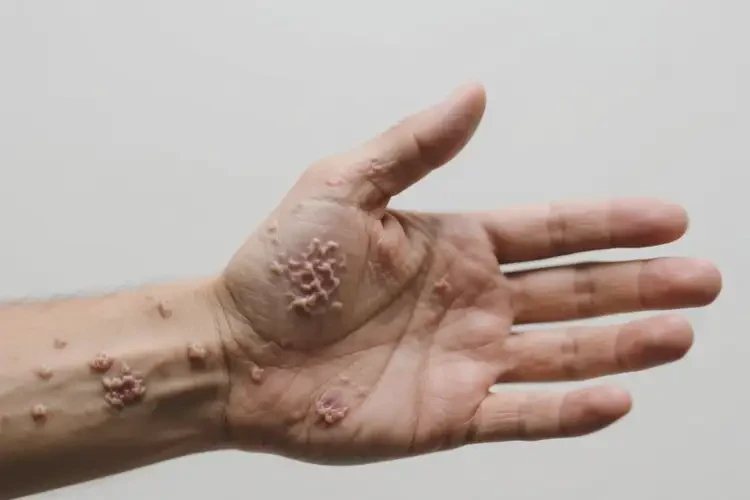 男生手臂上有濕疹可不可以根治(圖1)