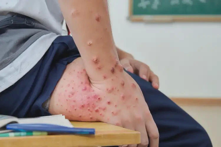 中學(xué)生屁股上出現(xiàn)濕疹可以徹底自愈嗎(圖4)