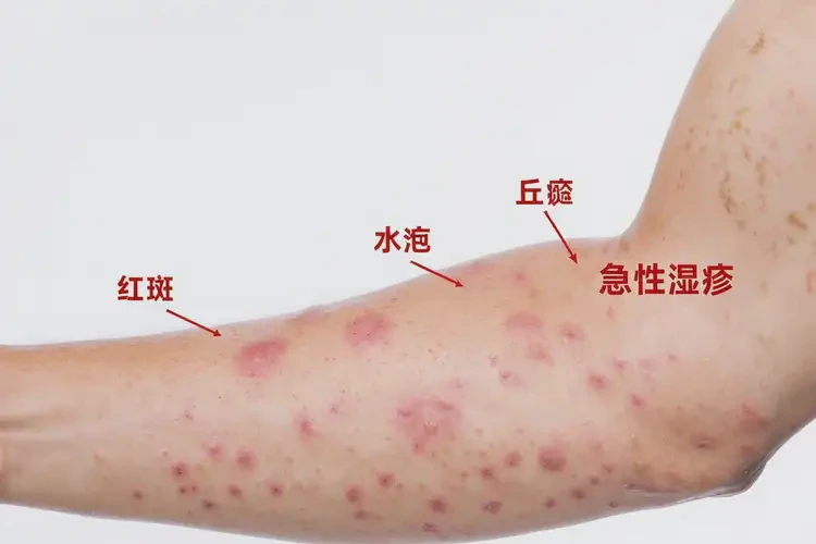 男生手臂上偶爾起濕疹可不可以根治(圖4)