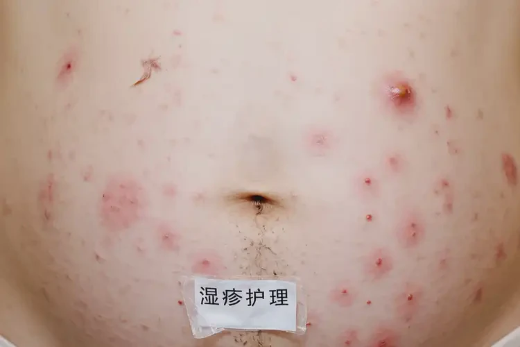 產(chǎn)婦肚子上出濕疹可不可以根治(圖4)